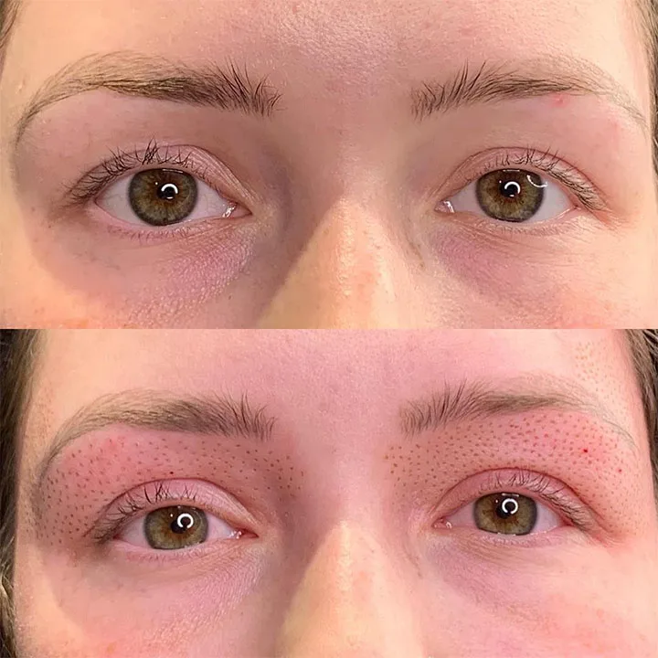 Plasma lift